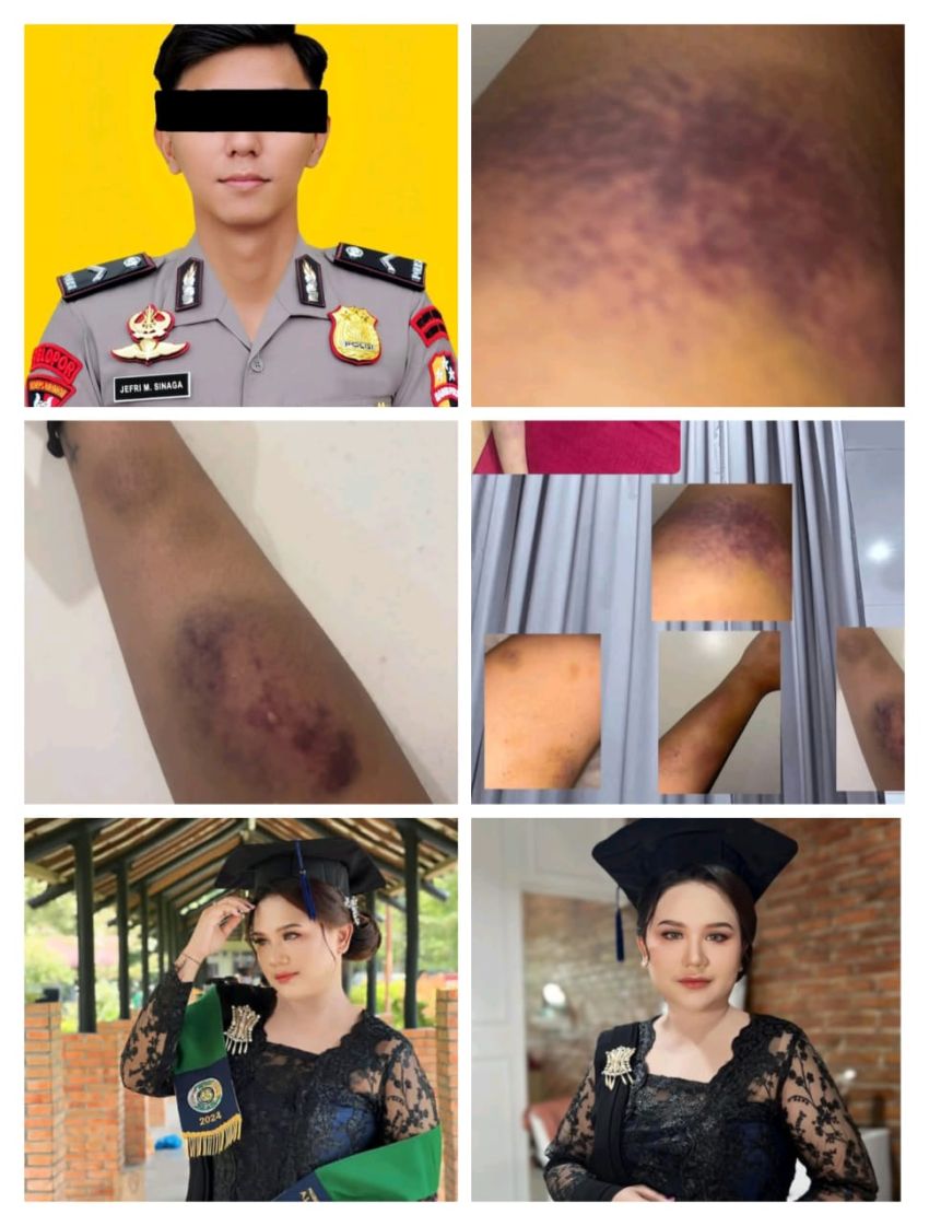 Cemburu Buta, Anggota Brimob Binjai Diduga Aniaya Pacar hingga Lebam