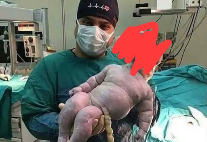 Dokter dan Bidan Deg-degan, Bayi 7,9 Kg Lahir Secara Normal